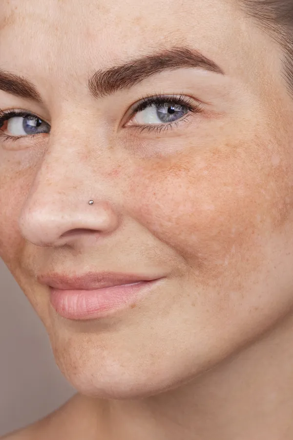 Rostro con manchas en la piel